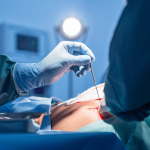 Qu’est-ce que la dénervation rénale et comment fonctionne-t-elle ?