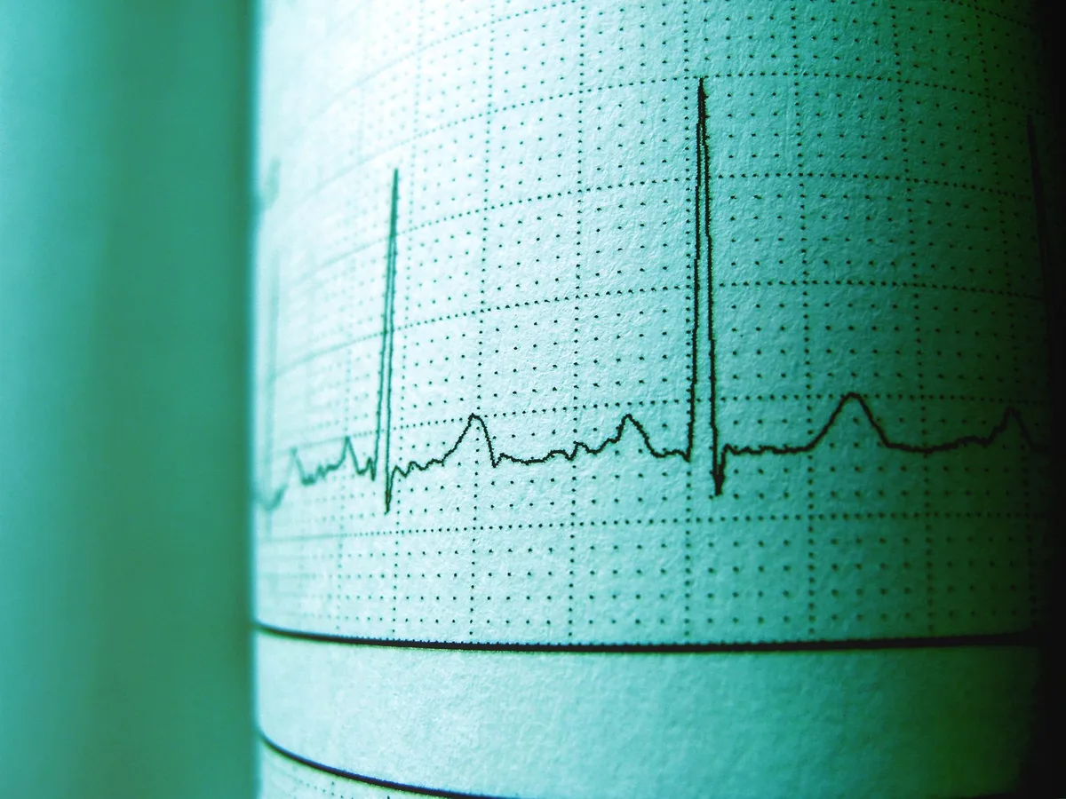 Écran médical affichant un tracé d'électrocardiogramme