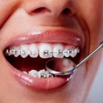 La surcomplémentaire orthodontie adulte est-elle remboursée par la Sécurité sociale ? Pharamond
