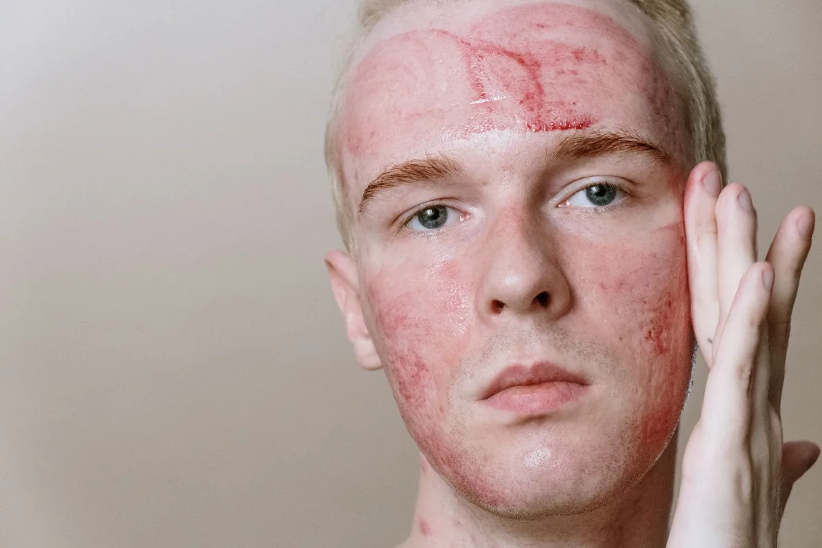 Peau affectée par l'acné inflammatoire avec boutons rouges et papules