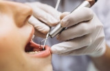 Blanchiment dentaire : la gouttière pour retrouver des dents éclatantes
