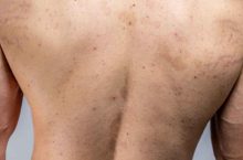 Que savoir sur la mycose cutanée et sa durée après traitement ?