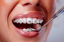 La surcomplémentaire orthodontie adulte est-elle remboursée par la Sécurité sociale ?