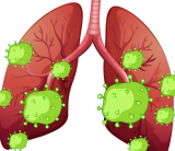 Quelle est l&rsquo;espérance de vie après une embolie pulmonaire ? Les données qui interpellent