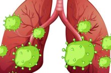 Quelle est l&rsquo;espérance de vie après une embolie pulmonaire ? Les données qui interpellent