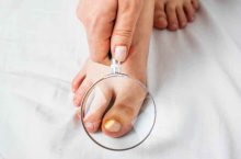 Traitement de la mycose de l’ongle du pied avec des huiles essentielles : l’astuce naturelle à tester